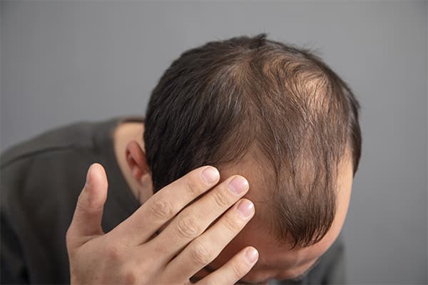 https://tower.besthairaware.com/wp-content/uploads/2024/10/Caucasian-man.-Hair-loss-problem.jpg